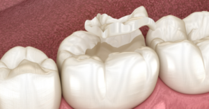 A lost filling or crown can be painful because the exposed tooth tissue is often sensitive to temperature, pressure or air.