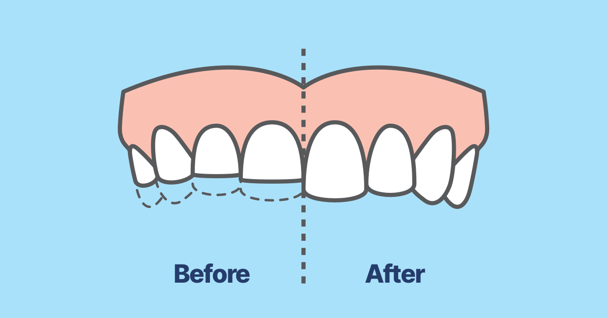 Teeth Grinding before and after