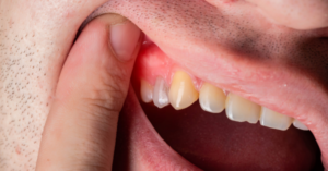 A tooth abscess is a pocket of pus that is caused by a bacterial infection. 